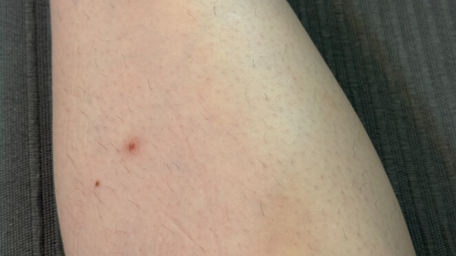 ジェントルマックスプロで5回施術したふくらはぎ