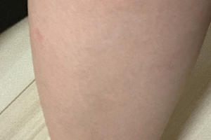 メディオスターモノリスで5回施術したすね