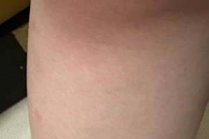 メディオスターモノリスで5回施術したひざ下