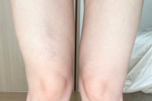 カロンSで5回施術したひざ上