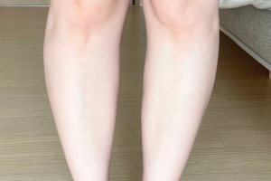 カロンsで5回施術を受けた足（ヒザ下）